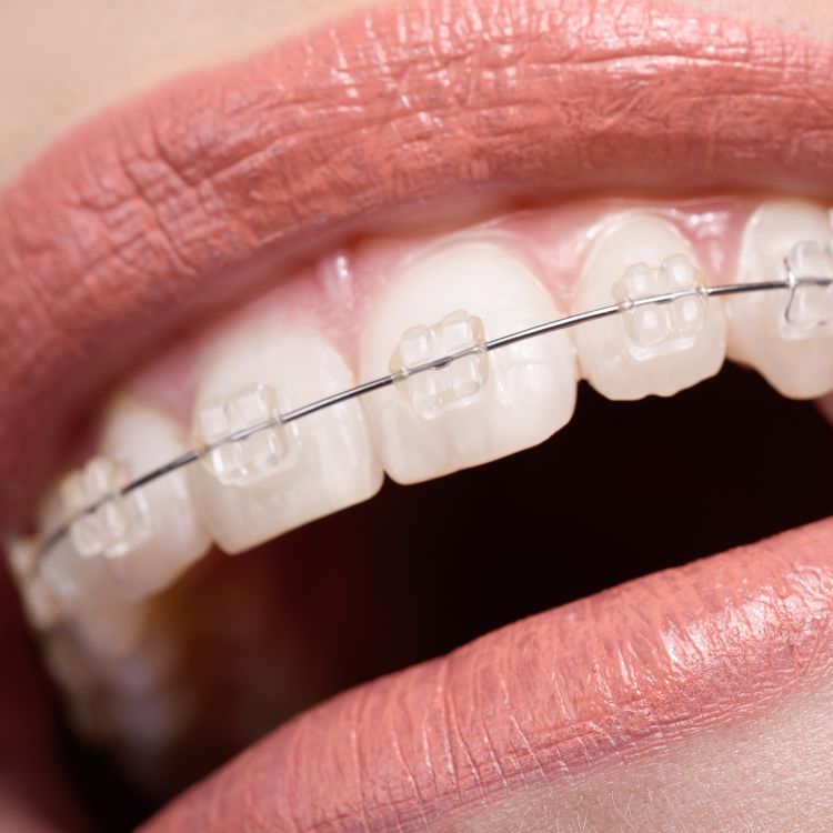 ceramic braces karamousli