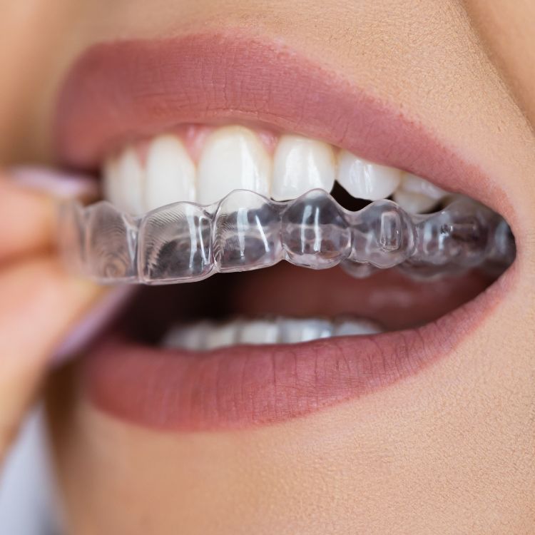 clear aligners karamousli