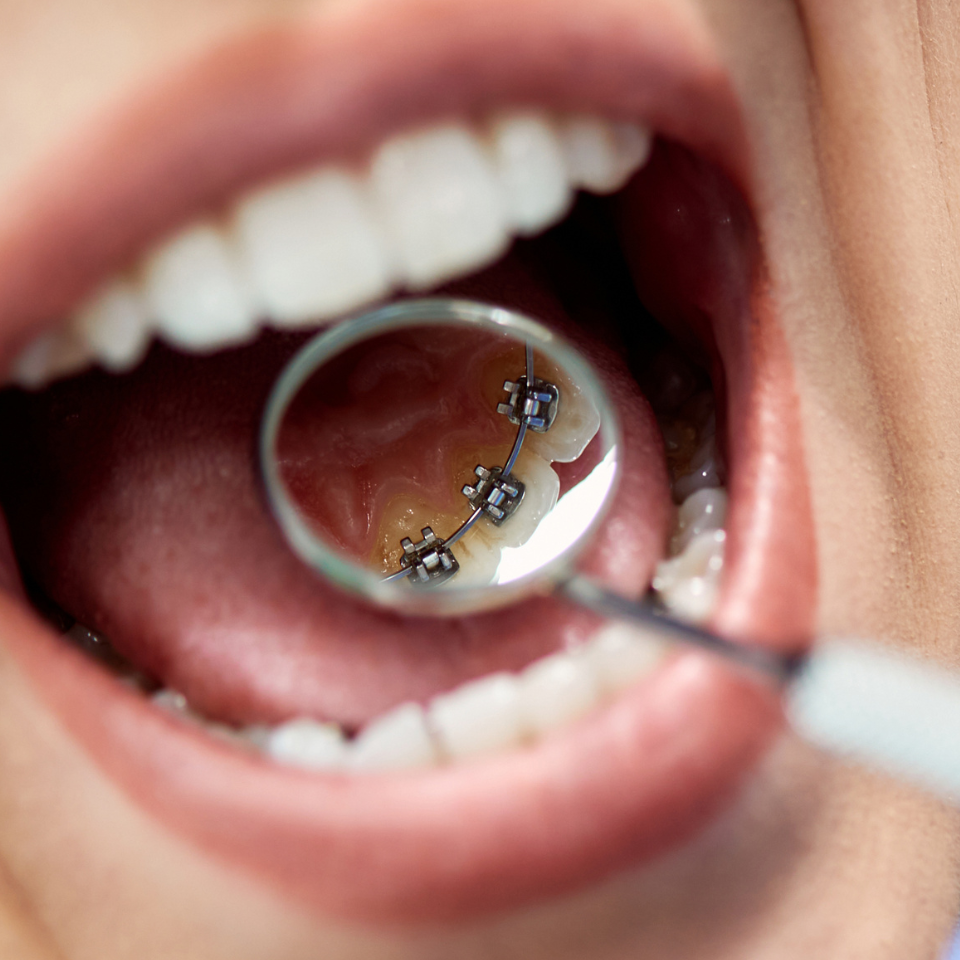 lingual braces karamousli